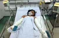Bé gái bị mẹ đốt đang nguy kịch